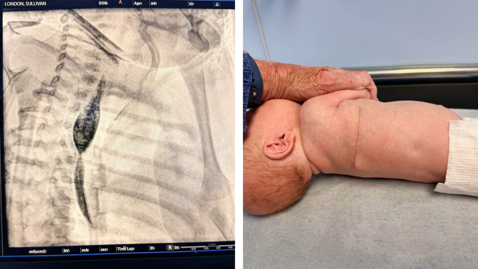 Medical contrast image of Sullivan’s esophagus beside a photo showing his healing surgical scar
